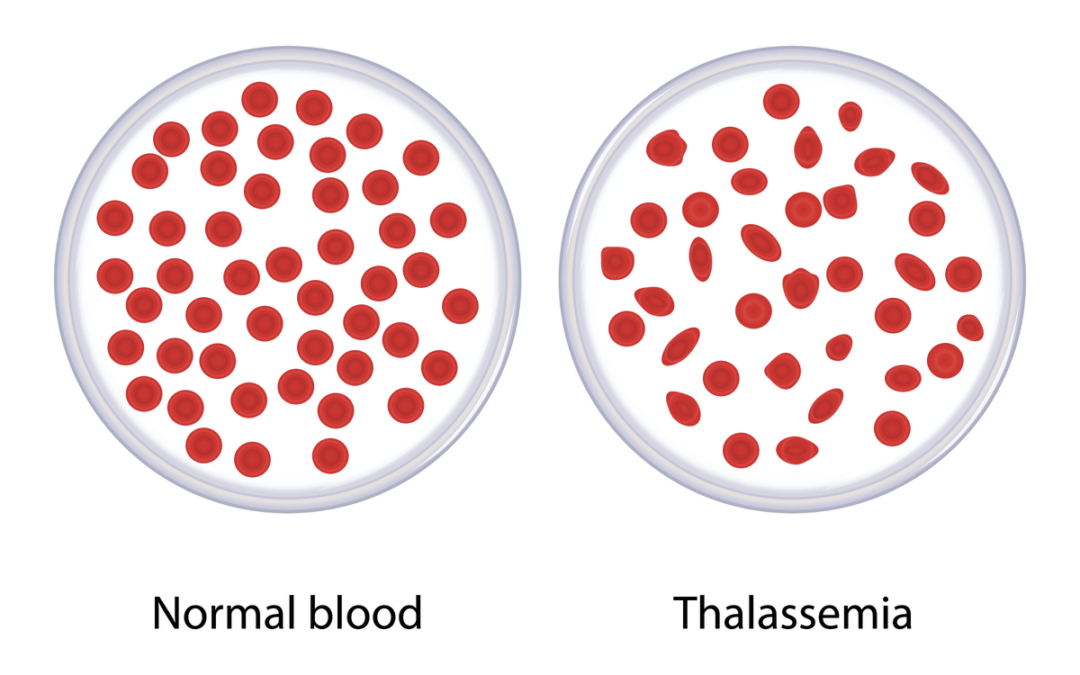 Thalassemia – Signs implication and Treatment – ASB