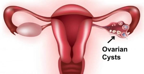 Ovarian-dystrophy Causes Natural Treatment-ASB