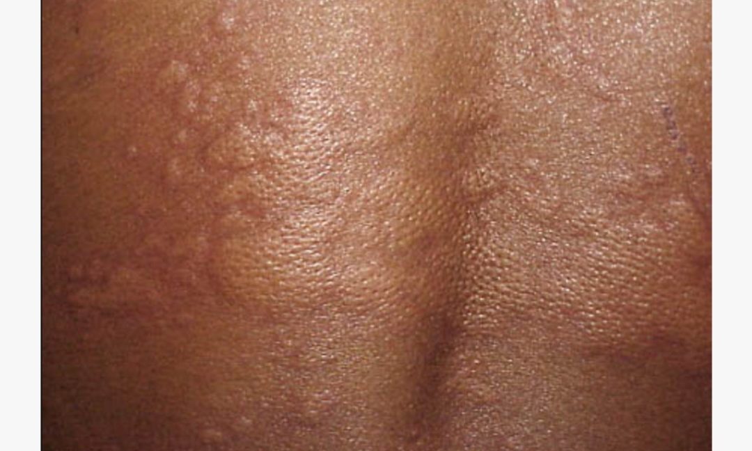 Urticaria-Causes Signs-Natural Treatment
