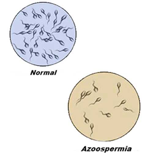 Azoospermia Definition Causes Natural Treatment Azoospermia