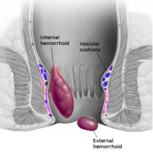 Hemorrhoids constipation natural treatment