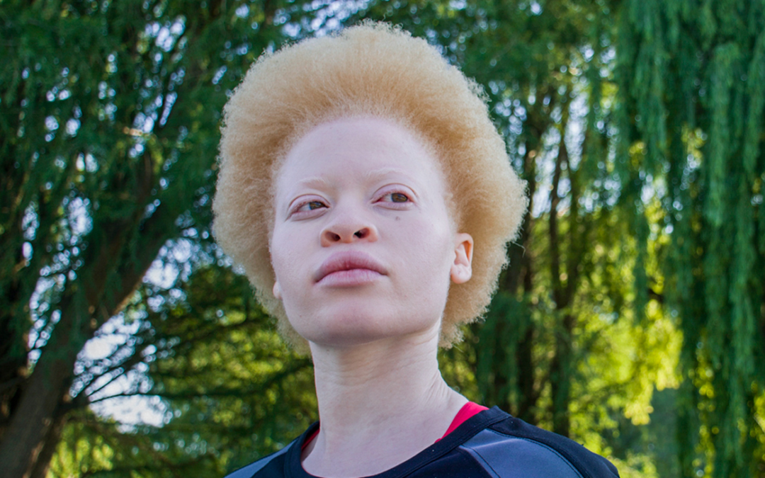 Albinism Incredible Natural disease